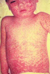 pictures_of_measles_2